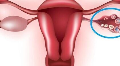 Ovarian Cysts: Causes and Symptoms